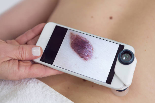 Smartphone mit Dermatoskop untersucht Hautmal am Rücken